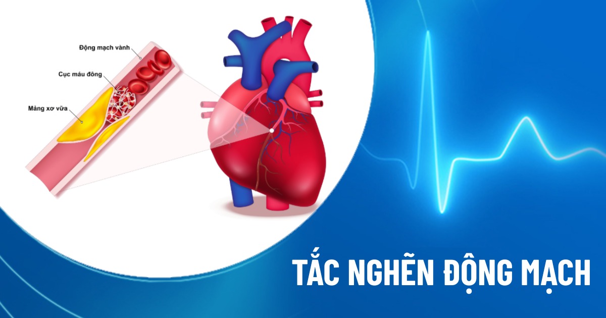 tắc nghẽn động mạch