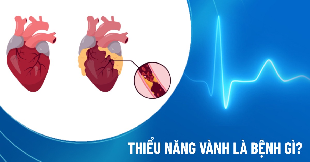 thiểu năng vành